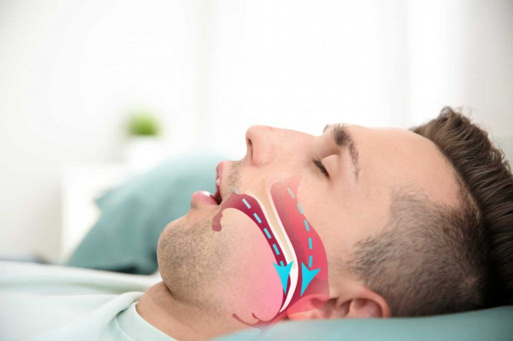 airway-management-sleep-apnea-in-oakville-olde-oakville-dental